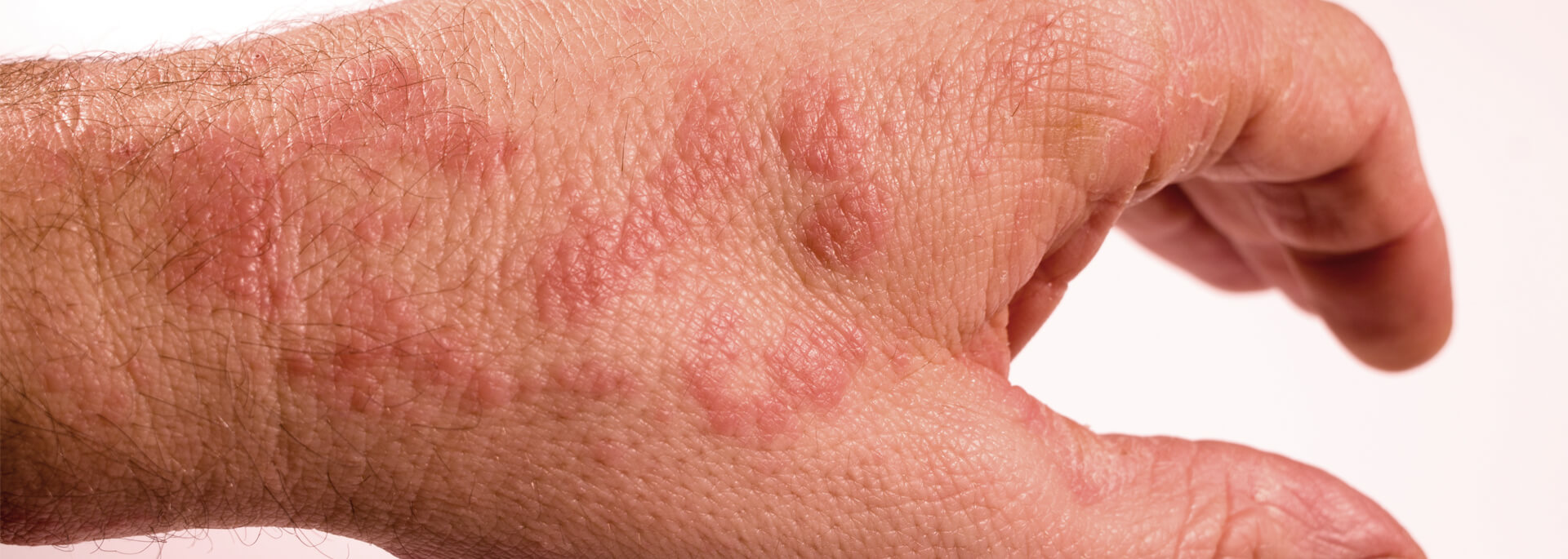 Rękawiczki jednorazowe dla alergików - jakie wybrać?